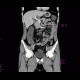 Chronic inflammatory changes of terminal ileum and rectum, pelvic lipomatosis: CT - Computed tomography